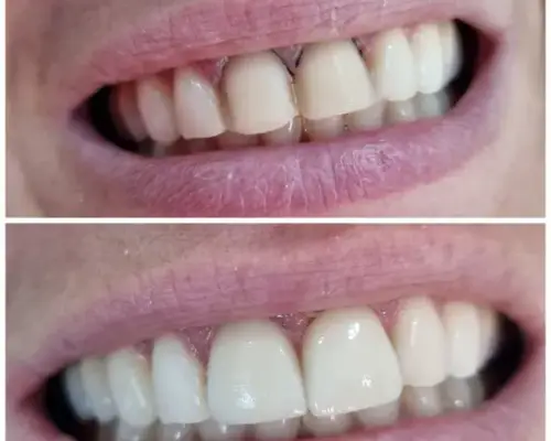 Antes e depois — Restauração