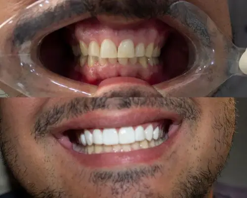 Antes e depois — Facetas de Resina